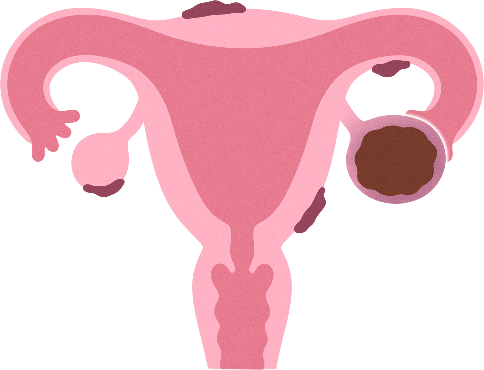 子宮内膜症について