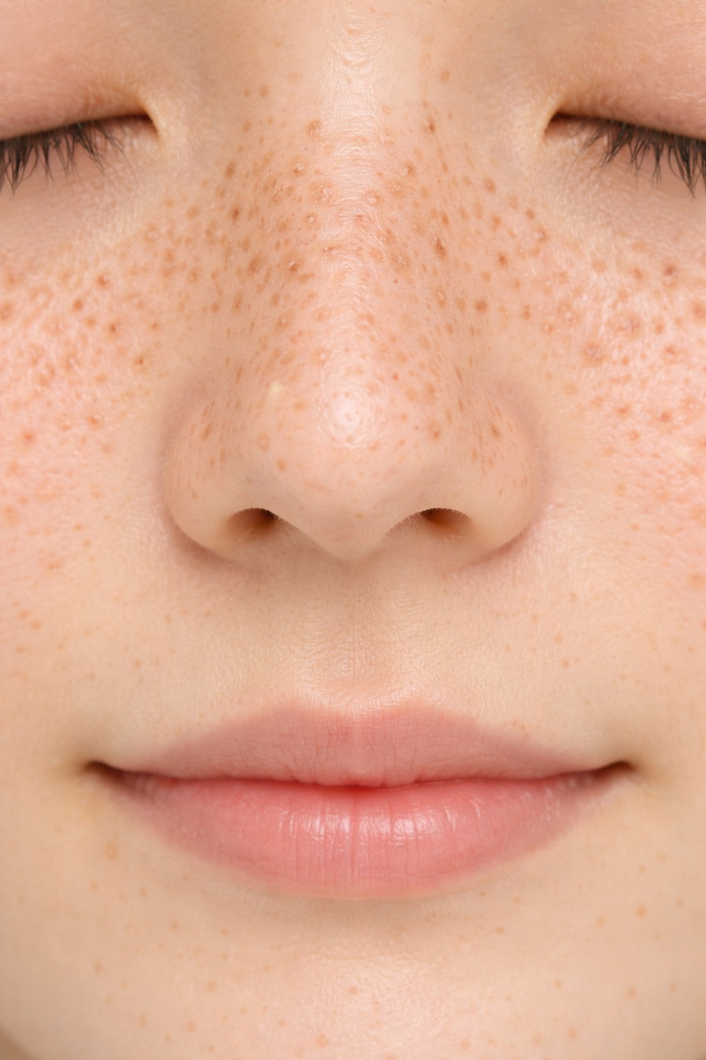 そばかす（雀卵斑）