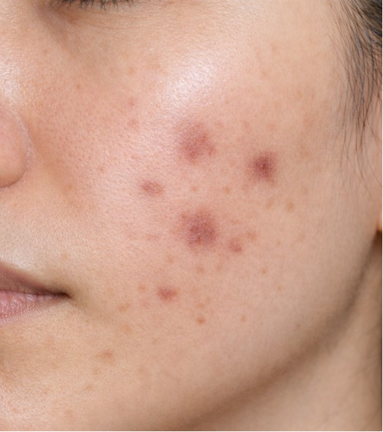 炎症後色素沈着