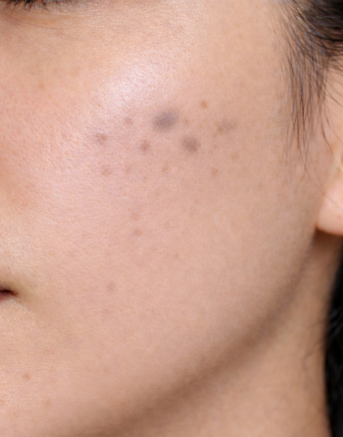 ADM（後天性真皮メラノサイトーシス）