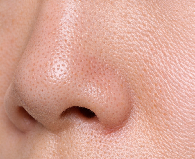 開き毛穴（オレンジスキン）