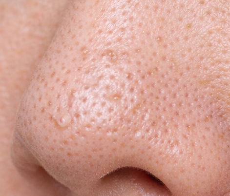 詰まり毛穴（角栓毛穴）