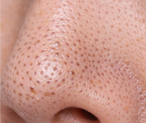 黒ずみ毛穴（酸化毛穴）