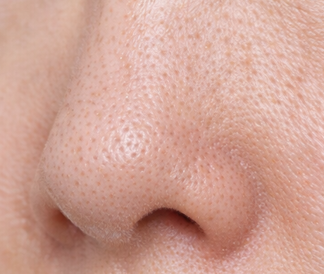 たるみ毛穴（縦長毛穴）