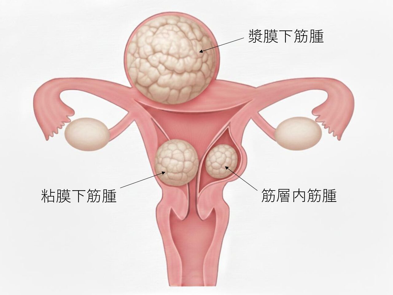 子宮筋腫とは？種類・症状・治療の考え方を専門医が解説