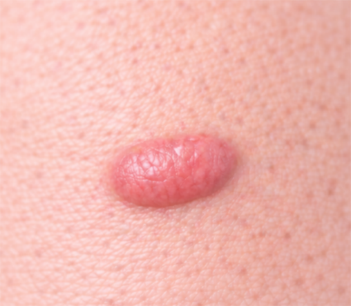 肥厚性瘢痕、ケロイド