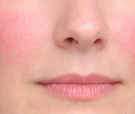 毛細血管拡張(赤ら顔)