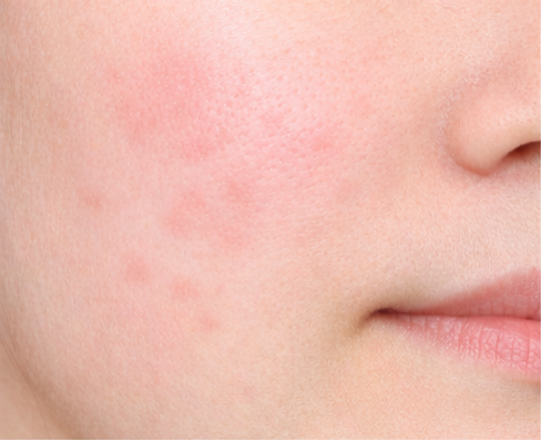 炎症後紅斑(ニキビ跡の赤み)