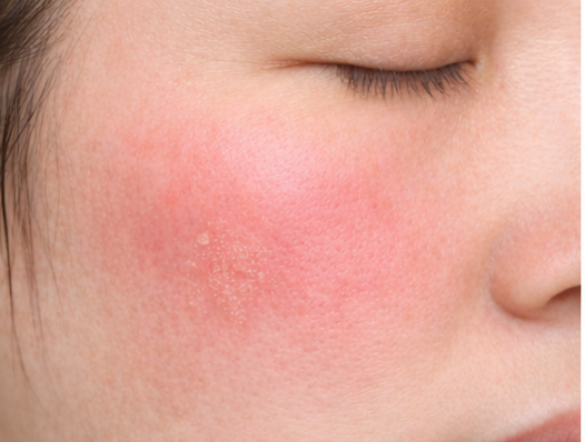 接触皮膚炎・敏感肌(バリア機能低下)